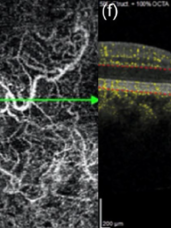 Spectre des Pachychoroïdes