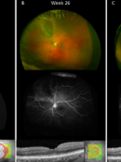 Rétinopathie post radique sous Aflibercept