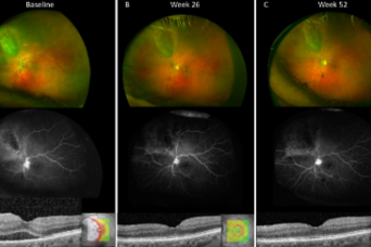 Rétinopathie post radique sous Aflibercept
