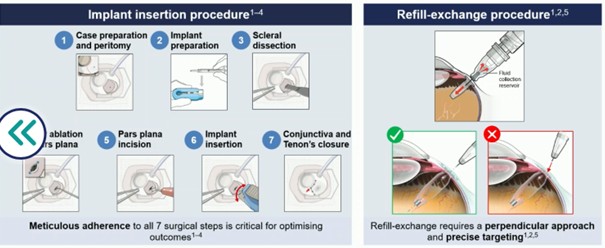 Étapes pour la procédure d'insertion des implants Port Delivery System