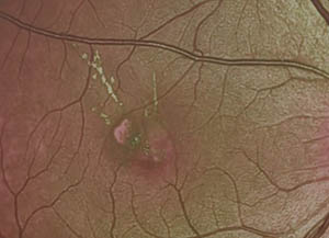Photocoagulation sélective au laser pour PVAC
