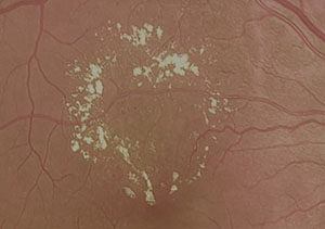 Photocoagulation sélective au laser pour TelCaps