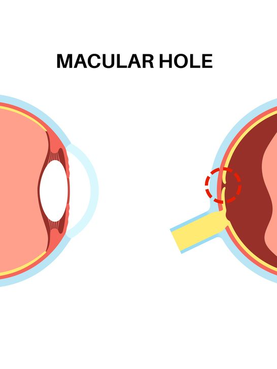 Macular hole