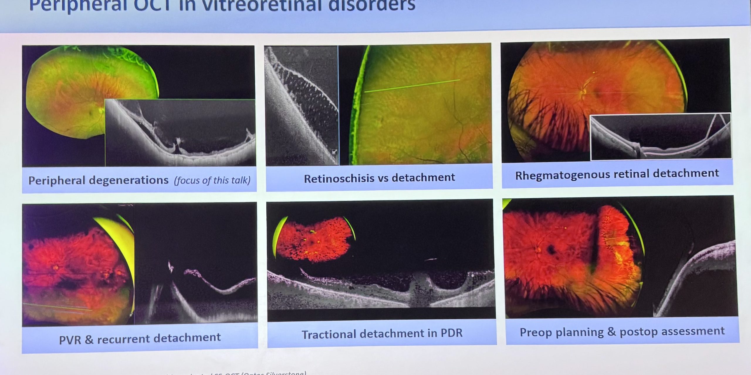 Les différents diagnostics possibles avec l’OCT-UWF