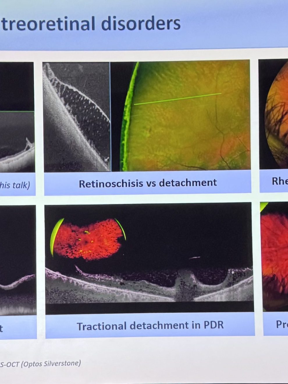 Les différents diagnostics possibles avec l’OCT-UWF