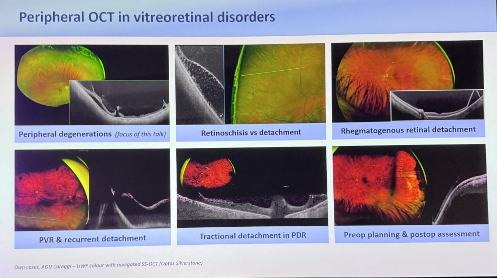 Les différents diagnostics possibles avec l’OCT-UWF