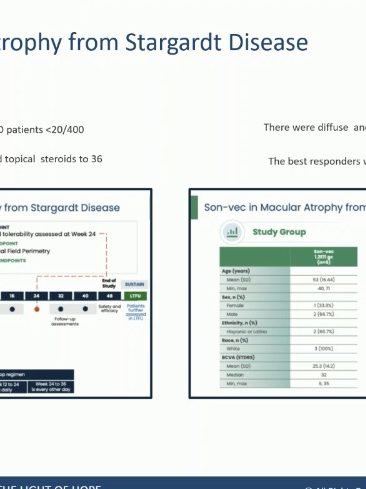 Les résultats de MCO-010 dans la DMLA atrophique