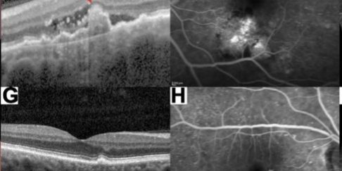 Vasculopathie polypoïdale : une même étiquette, quatre profils PCV-DMLA